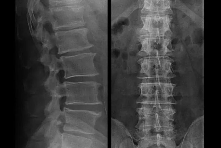 osteohondroza na rendgenskom snimku