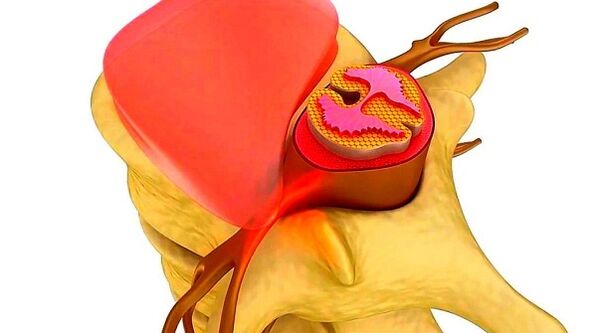 Osteohondroza torakalne kralježnice suština bolesti