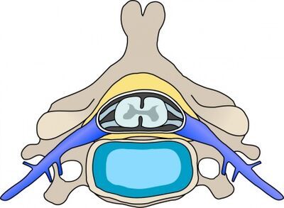 Protabij u kralježnici s cervikalnom osteohondrozom